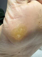 Usunięcie odcinków